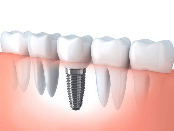 Dental Implants Islington - Archway Dental Group