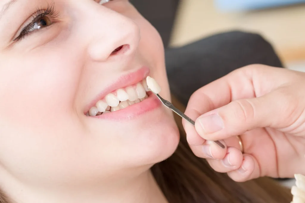 How Much Are Veneers? A Complete Guide for Patients 2 Dental Veneers